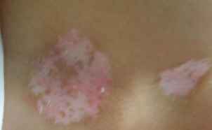 白癜风症状 白癜风症状