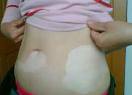 白癜风症状 白癜风症状