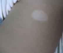 白癜风症状 白癜风症状