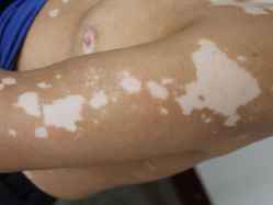 白癜风症状 白癜风症状