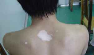 白癜风症状 白癜风症状