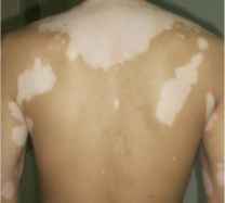 白癜风症状 白癜风症状