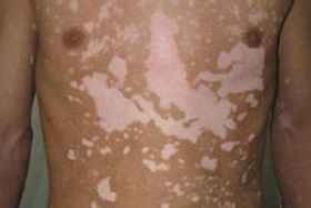 白癜风症状 白癜风症状