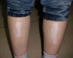 白癜风症状 白癜风症状