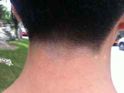 白癜风症状 白癜风症状