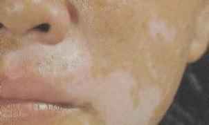 白癜风症状 白癜风症状