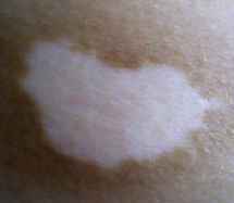 白癜风症状 白癜风症状