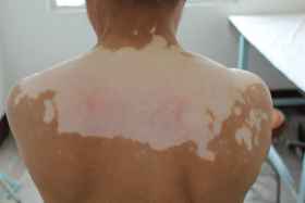 白癜风症状 白癜风症状