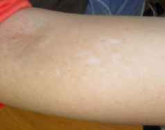 白癜风症状 白癜风症状