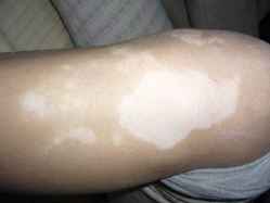 白癜风症状 白癜风症状