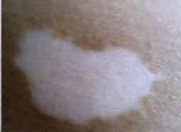 遗传性白癜风到底能不能治好