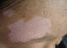 夏季怎样治疗颈部白癜风最好