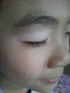 手臂白癜风如何治疗