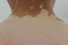 针灸治疗白癜风效果怎么样