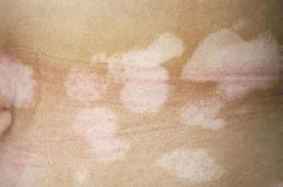 儿童脚跟长白癜风是什么原因引发的